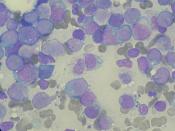 English: Myeloblasts with Auer rods seen in Acute Myeloid Leukemia (AML). Português do Brasil: Mieloblastos com bastonetes de Auer vistos na Leucemia Mieloide Aguda (LMA).