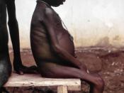A seated, listless child, who was among many kwashiorkor cases found in Nigerian relief camps during the Nigerian–Biafran War.