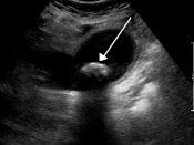 English: A 1.9 cm gallstone impacted in the neck of the gallbladder and leading to cholecystitis. Note the 4 mm gall bladder wall thickening.