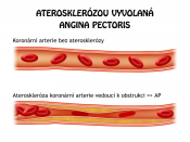 Coronary arthery atherosclerosis leeds to obstruction and thus to angina pectoris.