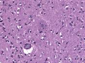 English: Biopsy specimen displaying a neuritic plaque in a case of Alzheimers Disease