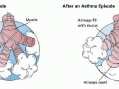 Asthma before-after
