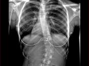English: X-ray of U.S. girl, age 16 years 8 months, with pre-operative scoliosis. Front, standing, clothed.