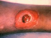 A diphtheria skin lesion on the leg. Corynebacterium diphtheriae can not only affect the respiratory system, but the skin as well, where it manifests as an open wound.