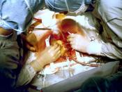 http://fmp.cit.nih.gov/hi/ Title: Coronary artery bypass surgery Image ID: 657 B Photographer: Jerry Hecht Restrictions: Public Domain Image Date: 10/1/1981 Slovenščina: Kardiovaskularna kirurgija: koronarni bypass arterije.