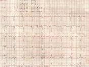 An ECG with prolonged QT interval.