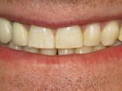 English: Photograph of mild fluorosis. Most noticeable on the upper right central incisor (tooth #8) (FDI-schema: 11)
