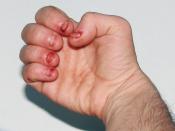 English: Dermatophagia - extreme nail biting / biting of skin to point of an obsessive compulsive disorder (OCD) or other condition leading to self mutilating behaviour such as autistic spectrum disorders (as is the case in this example) or Lesch-Nyhan Sy
