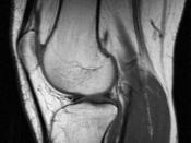 Image from an MRI examination of the knee with a displaced patella
