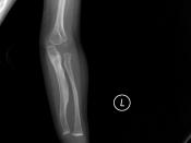 Osteogenesis Imperfecta (OI) Type V in 11 months kid.