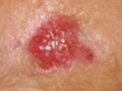 English: Skin cancer of the check. Query basal cell?