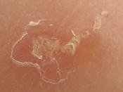 Close-up photo of a scabies burrow. The large scaly patch at the left is due to scratching. The scabies mite traveled toward the upper right and can be seen at the end of the burrow.