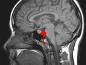 Image of the human head with the brain. The arrow indicates the position of the hypothalamus.