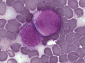 Leukemia cells.
