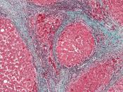 High magnification micrograph of a liver with cirrhosis. Trichrome stain. The most common cause of cirrhosis in the Western world is alcohol abuse - the cause of cirrhosis in this case.