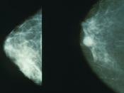 Breast implant: Mammographs: Normal breast (left) and cancerous breast (right).