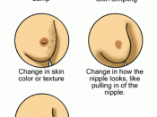 Early signs of breast cancer.