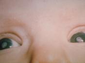 Bilateral cataracts in an infant due to congenital rubella syndrome