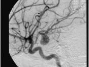 Angiograph of an aneurysm in a cerebral artery. Nederlands: Angiografie van een aneurysma in een cerebraal arterie.