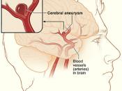 Diagram of cerebral aneurysm