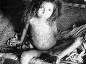 English: This child is showning the pan-corporeal rash due to the smallpox variola major virus. Smallpox is a serious, contagious, and sometimes fatal infectious disease. The name smallpox is derived from the Latin word for “spotted” and refers to the rai