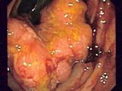 Endoscopic image of colon cancer identified in the sigmoid colon on screening colonoscopy for Crohn's disease