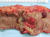 English: Gross appearance of an opened colectomy specimen containing an invasive colorectal carcinoma and two adenomatous polyps.