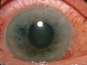 English: Photograph showing acute angle-closure glaucoma which is a sudden elevation in intraocular pressure that occurs when the iris blocks the eye's drainage channel—the trabecular meshwork.