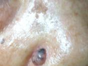 English: basal cell carcinoma of nose
