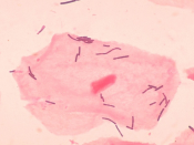 English: Lactobacillus organisms and vaginal squamous epithelial cell. Bacteria appeared as gram-positive rods among squamous epithelial cells and neutrophils in this vaginal smear.