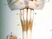 English: Detail of plate 4, figure 4 of Pathological Anatomy: Illustrations of the Elementary Forms of Disease. Last fasciculi published in 1838. Depicts Multiple Sclerosis lesions before the disease had been described by Charcot.