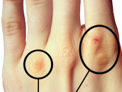 English: Russell's Sign on the knuckles of the index and ring fingers.