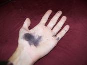 English: A hand stained black by silver nitrate, 17 hours after contact.