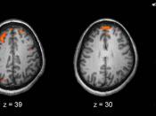 English: Image showing brain areas more active in controls than in schizophrenia patients during a working memory task during a fMRI study. Two brain slices are shown.
