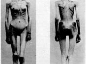 English: Two images of an anorexic female patient in a French medical journal Nouvelle Iconographie de la Salpêtrière vol 13, published in 1900. Français : Un cas d'anorexie hystérique, Nouvelle Iconographie de la Salpêtrière tome 13, publié en 1900.