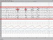 English: Stage 2 sleep. Sleep spindles highlighted by red line...EEG highlighted by red box.