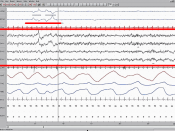 Polysomnography (PSG) is a multi-parametric test used as a diagnostic tool in sleep medicine.