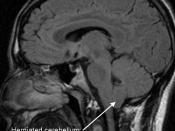 English: Image of a Type 1 Arnold-Chiari Malformation. The cerebellum has descended 7mm and there are herniated cerebellar tonsils into the foramen magnum.