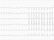 English: ECG from a man with bradycardia-tachycardia syndrome following mitral valvuloplasty, resection of the left atrial appendage and maze procedure. The ECG shows atrial fibrillation at around 126 beats per minute.