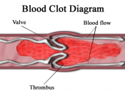 Blood clot diagram (Thrombus)