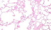 English: Low magnification micrograph of emphysema. H&E stain. The left of image shows severe emphysema (large empty spaces). The lung tissue on the right of the image has relative preservation of the alveoli. The top of the image is very near the pleural