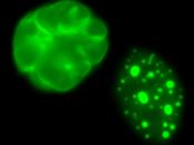 English: Untreated cells from children with the genetic disease progeria (left) compared to similar cells treated with farnesyltransferase inhibitors (FTIs). In the test tube, FTIs reverse the nuclear damage caused by the disease.