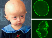 Hutchinson-Gilford Progeria Syndrome. HGPS is a childhood disorder caused by mutations in one of the major architectural proteins of the cell nucleus. In HGPS patients the cell nucleus has dramatically aberrant morphology (bottom, right) rather than the u
