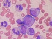 English: Bone marrow examination of cells with Wright's stain showing neutrophil precursors: Promyelocyte in the middle, two metamyelocytes next to it, two band cells and segmented neutrophils at the top left.