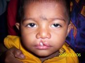 English: This is a picture of a 19 month old male child with unilateral cleft lip, right sided, taken by me with consent from the child's parents.