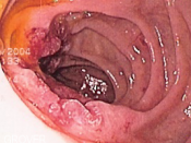 Endoscopic image of adenocarcinoma of duodenum seen in the post-bulbar duodenum. Photograph released under GFDL on permission of patient