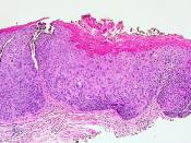 Vulvar Intraepithelial Neoplasia, Grade 3 (VIN 3)