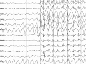 EEG shows abnormal activity in some types of seizure disorder, but may or may not display abnormal findings in PTE.