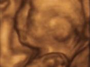 A 3D ultrasound taken of a fetus at 20 weeks.