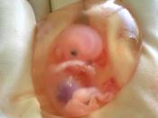 English: 44years old gravid female with previous 6 children, was diagnosed with carcinoma in situ of cervix (early stage cancer of womb). So total removal of uterus( woomb) considered with fetus in situ, for long life of the female. So abortion was inevit